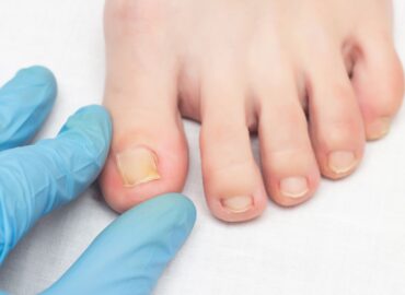 Can Regular Running Habits Lead to Ingrown Toenails?