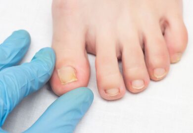 Can Regular Running Habits Lead to Ingrown Toenails?