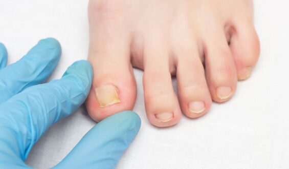 Can Regular Running Habits Lead to Ingrown Toenails?